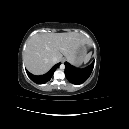 Carcinoma colon - hepatic flexure (Radiopaedia 19461-19493 A 23).jpg