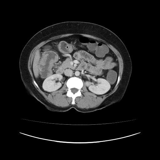 File:Carcinoma colon - hepatic flexure (Radiopaedia 19461-19493 A 52).jpg