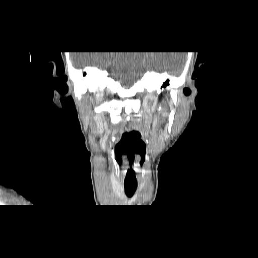 Carcinoma of the maxillary antrum (Radiopaedia 53805-59888 Coronal C+ delayed 97).jpg