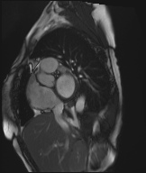 Cardiac amyloidosis (Radiopaedia 51404-57150 Sagittal CINE SSFP 292).jpg