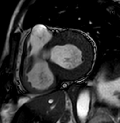 Cardiac amyloidosis - ATTR wild-type (Radiopaedia 74412-85296 short axis cine SSFP 135).jpg