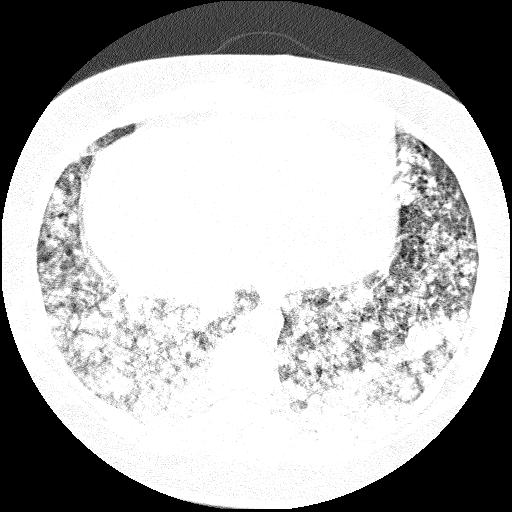 File:Cardiac angiosarcoma (Radiopaedia 66010-75181 Axial lung window 15).jpg
