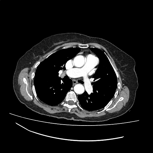 File:Cardiac hydatid disease (Radiopaedia 64684-73611 Axial with contrast 20).jpg