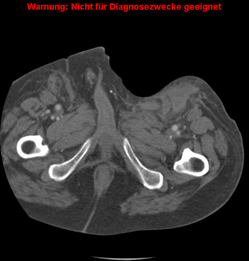 File:Cardiac perforation following transcatheter aortic valve implantation (Radiopaedia 23714-23863 B 19).png