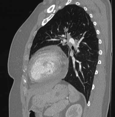 Cardiac sarcoidosis (Radiopaedia 74548-85534 Sagittal lung window 30).jpg