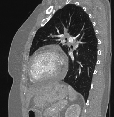 Cardiac sarcoidosis (Radiopaedia 74548-85534 Sagittal lung window 31).jpg
