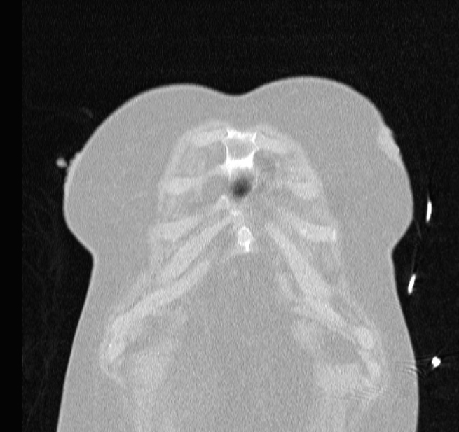 Cardiogenic pulmonary edema (Radiopaedia 29213-29609 Coronal lung window 4).jpg
