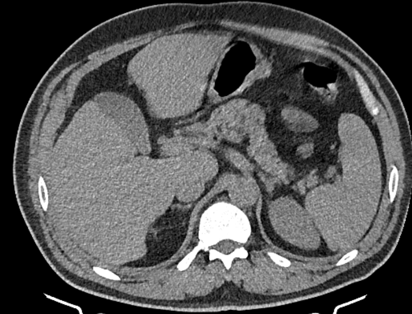 Cardiogenic pulmonary edema (Radiopaedia 68180-77678 Axial non-contrast 64).jpg