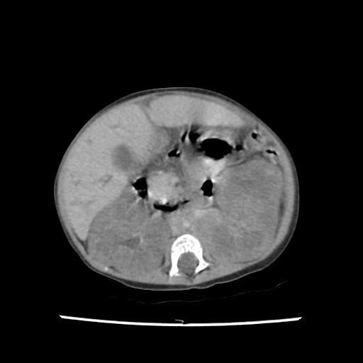 Caroli disease with autosomal recessive polycystic kidney disease (ARPKD) (Radiopaedia 89651-106703 B 103).jpg
