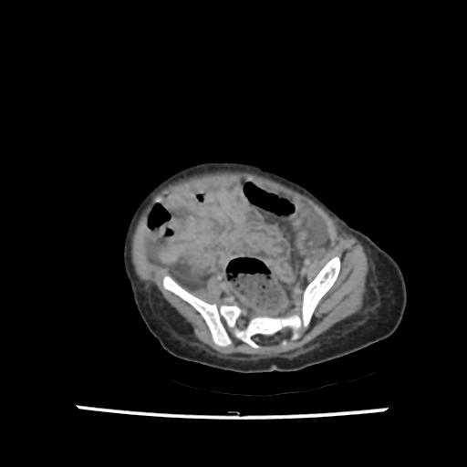 File:Caroli disease with autosomal recessive polycystic kidney disease (ARPKD) (Radiopaedia 89651-106703 B 184).jpg