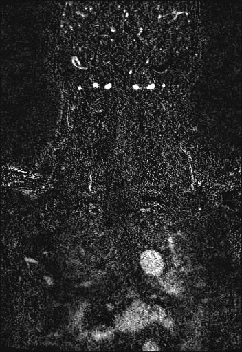 Carotid artery dissection (Radiopaedia 28441-28689 Coronal MRA 81).jpg