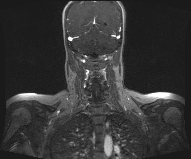 Carotid body tumor (Radiopaedia 12777-12912 MRA 56).jpg