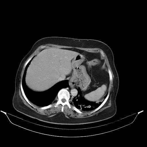 File:Carotid body tumor (Radiopaedia 21021-20948 A 50).jpg