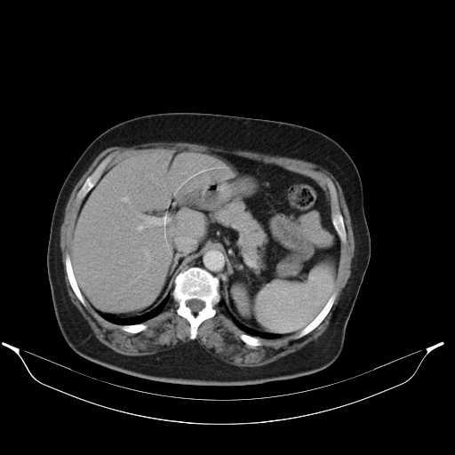 Carotid body tumor (Radiopaedia 21021-20948 A 55).jpg