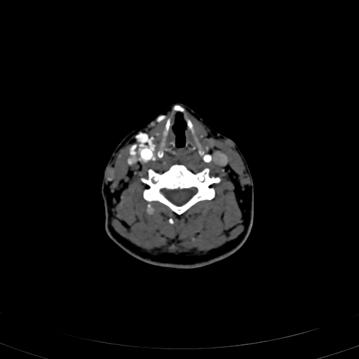 Carotid body tumor (Radiopaedia 83615-98727 A 75).jpg