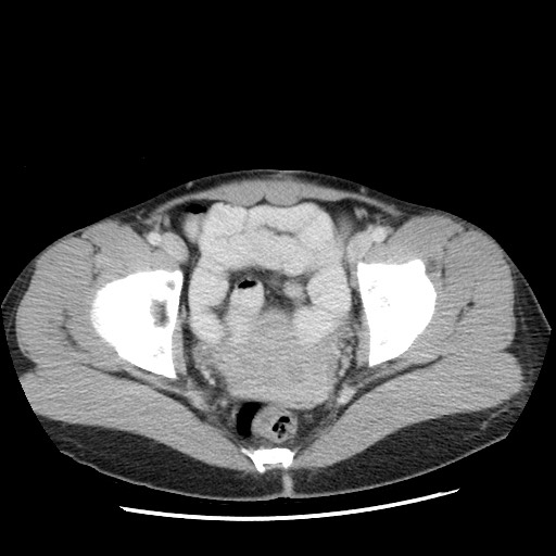 Castleman disease with fibrous pseudotumor in the abdomen (Radiopaedia 77296-89373 A 115).jpg