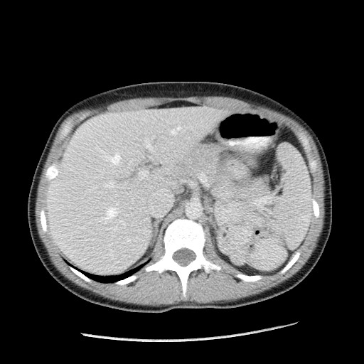 File:Castleman disease with fibrous pseudotumor in the abdomen (Radiopaedia 77296-89373 A 32).jpg