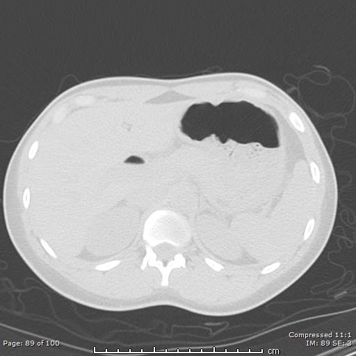 Catamenial pneumothorax (Radiopaedia 54382-60600 Axial non-contrast 89).jpg