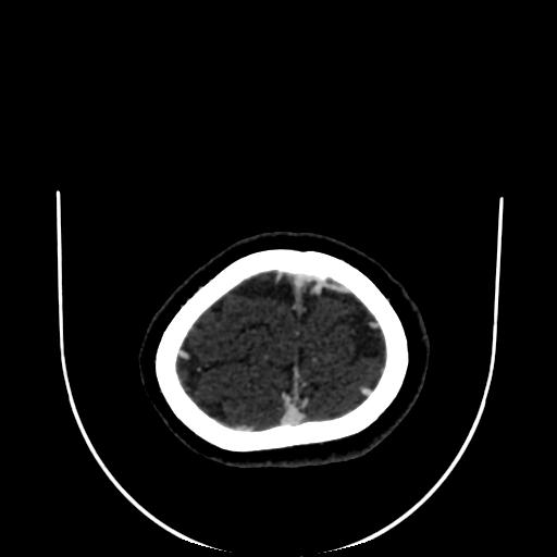 Cavernoma with developmental venous anomaly (Radiopaedia 22470-22506 C 185).jpg