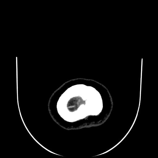 Cavernoma with developmental venous anomaly (Radiopaedia 22470-22506 C 203).jpg