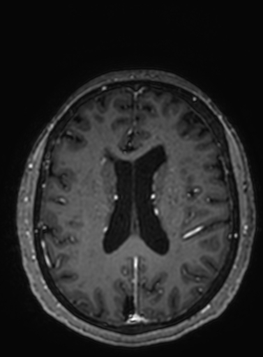 Cavernous hemangioma of the cerebellar falx (Radiopaedia 73025-83724 Axial T1 C+ 131).jpg
