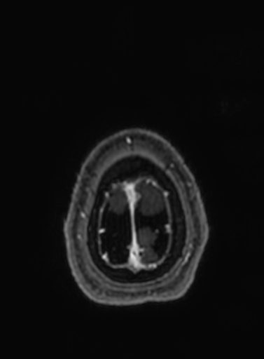 File:Cavernous hemangioma of the cerebellar falx (Radiopaedia 73025-83724 Axial T1 C+ 24).jpg