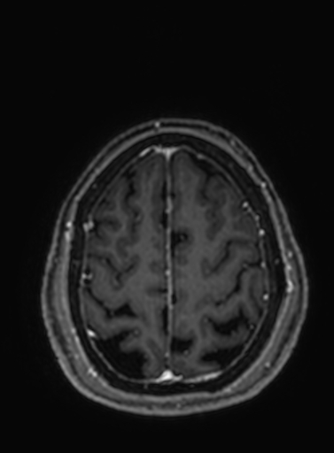 File:Cavernous hemangioma of the cerebellar falx (Radiopaedia 73025-83724 Axial T1 C+ 68).jpg