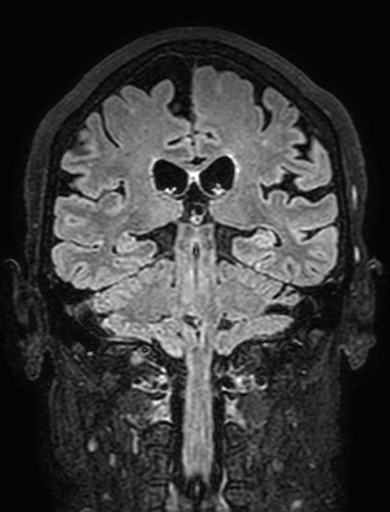 Cavernous hemangioma of the cerebellar falx (Radiopaedia 73025-83724 Coronal FLAIR 214).jpg