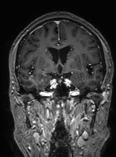 Cavernous hemangioma of the cerebellar falx (Radiopaedia 73025-83724 Coronal T1 C+ 166).jpg
