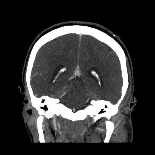 File:Cavernous sinus thrombosis (Radiopaedia 10619-11078 D 20).jpg