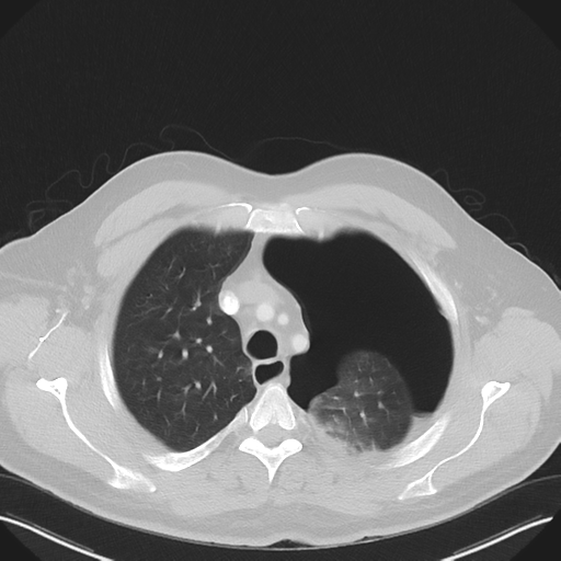 Cavitating pneumonia complicated by pneumothorax (Radiopaedia 48149-52994 Axial lung window 16).png