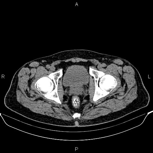 Cecal adenocarcinoma (Radiopaedia 85324-100916 Axial non-contrast 96).jpg