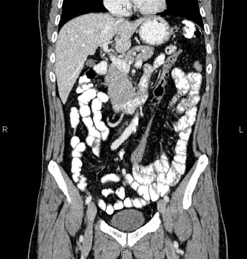 Cecal adenocarcinoma (Radiopaedia 85324-100916 D 25).jpg