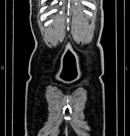 Cecal adenocarcinoma (Radiopaedia 85324-100916 D 67).jpg