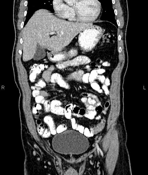 File:Cecal cancer with appendiceal mucocele (Radiopaedia 91080-108651 D 22).jpg