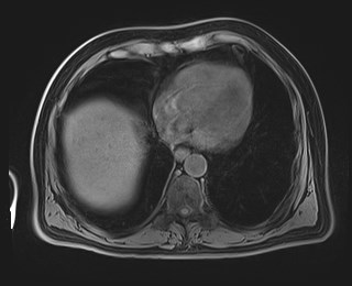 Cecal mass causing appendicitis (Radiopaedia 59207-66532 Axial T1 17).jpg