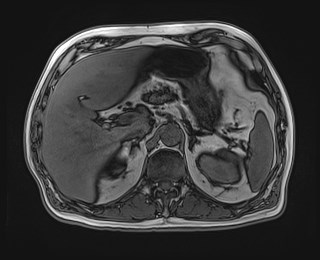 Cecal mass causing appendicitis (Radiopaedia 59207-66532 D 41).jpg