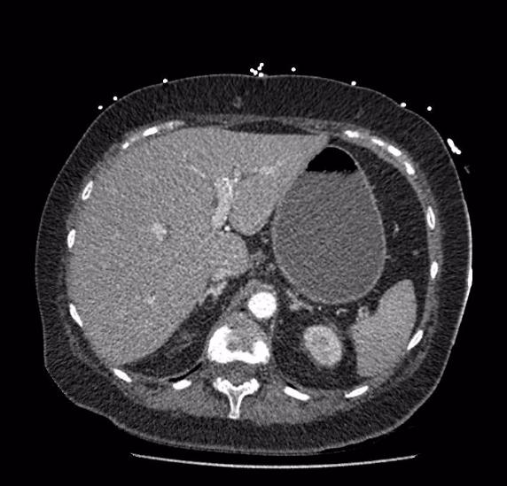 Celiac artery severe stenosis and dissection (Radiopaedia 44128-47842 B 19).jpg