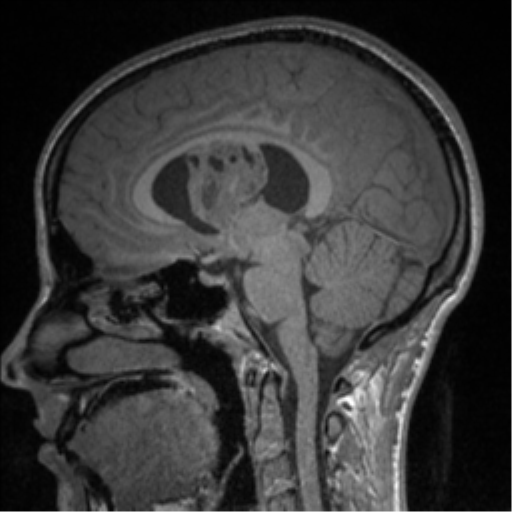 Central neurocytoma (Radiopaedia 37664-39557 Sagittal T1 48).png