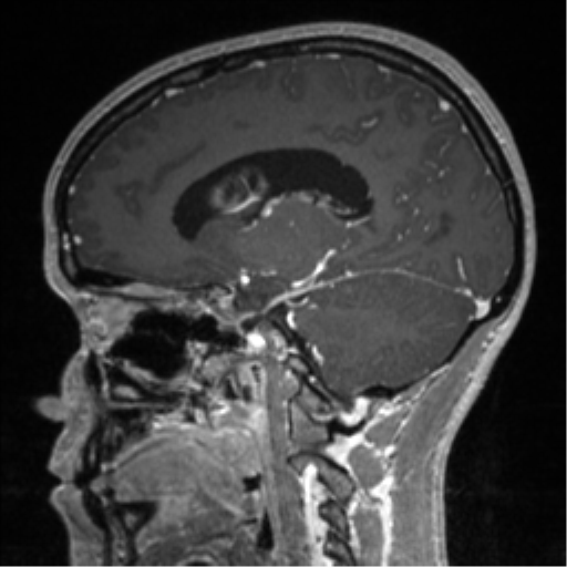 Central neurocytoma (Radiopaedia 37664-39557 Sagittal T1 C+ 58).png