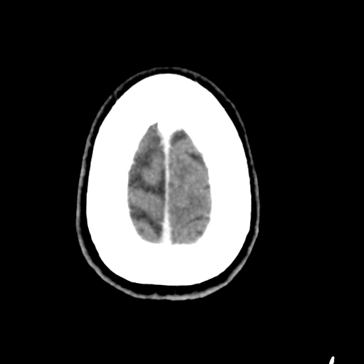 Central neurocytoma (Radiopaedia 65317-74346 Axial C+ delayed 45).png