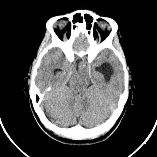 File:Central neurocytoma (Radiopaedia 84497-99871 Axial non-contrast 14).jpg