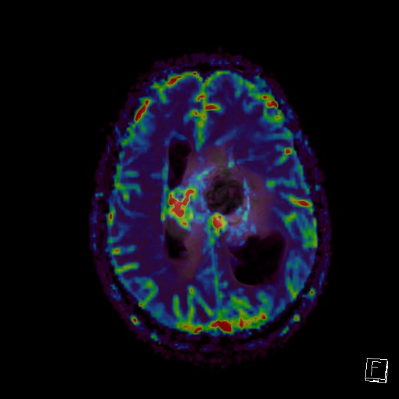 Central neurocytoma (Radiopaedia 84497-99872 Axial Perfusion 109).jpg