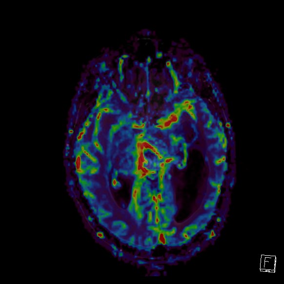 Central neurocytoma (Radiopaedia 84497-99872 Axial Perfusion 182).jpg