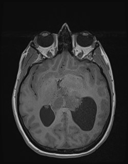 Central neurocytoma (Radiopaedia 84497-99872 Axial T1 99).jpg