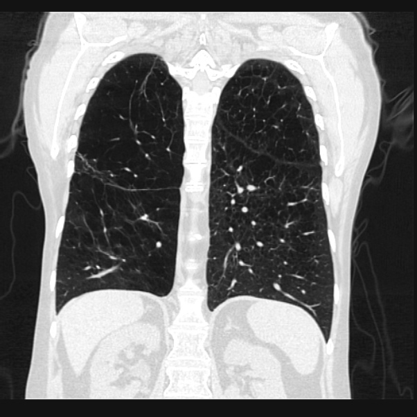 Centrilobular pulmonary emphysema (Radiopaedia 24495-24789 Coronal lung window 53).jpg