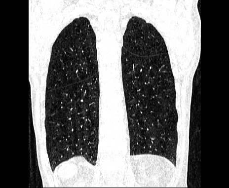 Centrilobular pulmonary emphysema (Radiopaedia 62468-70718 Coronal lung window 58).jpg