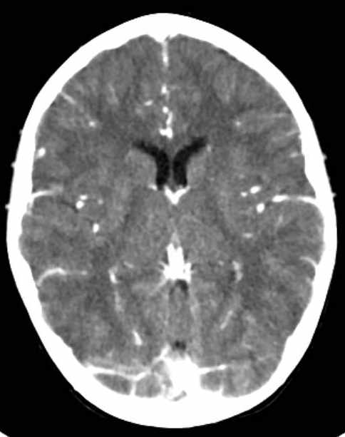 Cerebellar abscess (Radiopaedia 73727-84527 Axial C+ 44).jpg