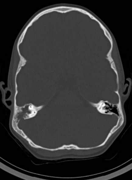 Cerebellar abscess (Radiopaedia 73727-84527 Axial bone window 28).jpg