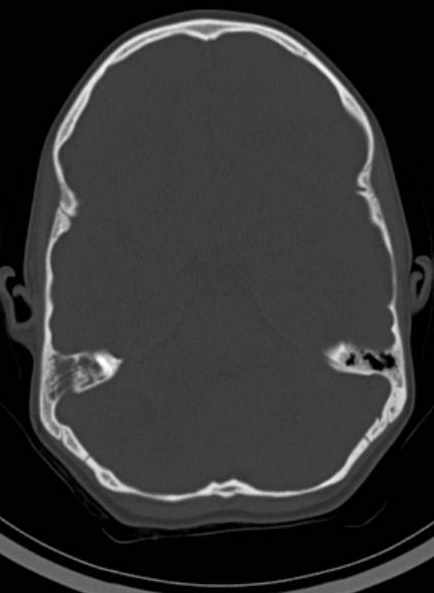 File:Cerebellar abscess (Radiopaedia 73727-84527 Axial bone window 29).jpg
